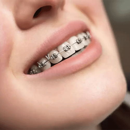 brackets